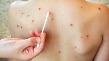 Se reactiva la alerta sanitaria nacional por un nuevo caso de sarampión