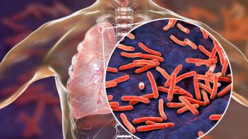 Alarma por el aumento de tuberculosis en Argentina: suben los casos un 38%
