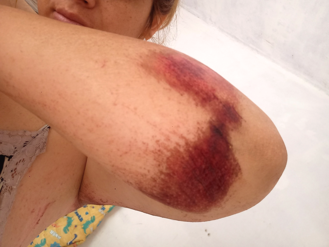 Una joven fue víctima de un motochorro: “Me salvé, lo estoy contando gracias a Dios”