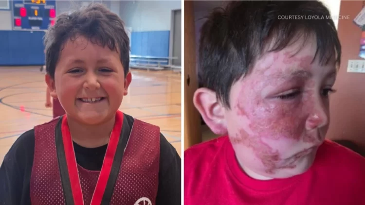 Un reto viral de TikTok provocó graves quemaduras en un niño de 9 años