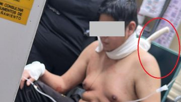 La Banda: llegó al hospital con un cuchillo incrustado en la columna tras un violento intento de robo