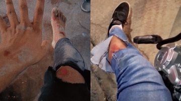 Una joven se accidentó tras ser atacada por perros en Las Termas: “¿De quién son? De nadie”