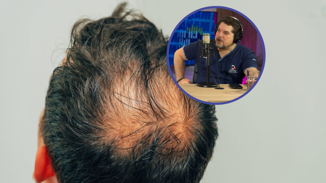 Dr. Federigi Chaud “Cuando el pelo se cae, nada lo hará volver a crecer; no hay producto o masaje milagroso”