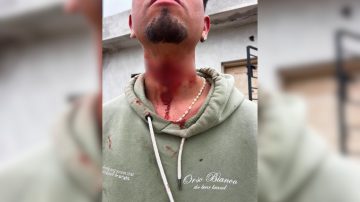 Barrio Siglo XIX: discutió con su pareja y se provocó cortes en el cuello